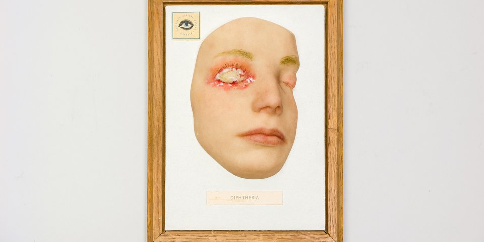 Moulage Diphterie, Gesicht halbrechts, Berliner Medizinhistorisches Museum der Charité. Copyright: Berliner Medizinhistorisches Museum der Charité, Foto: Felix Sattler.